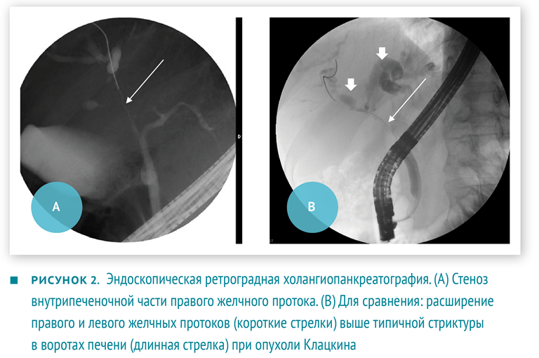 эндоскопическая ретроградная холангиопанкреатография.png